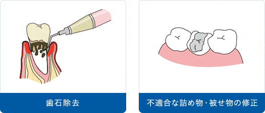 歯石除去 不適合な詰め物・被せ物の修正