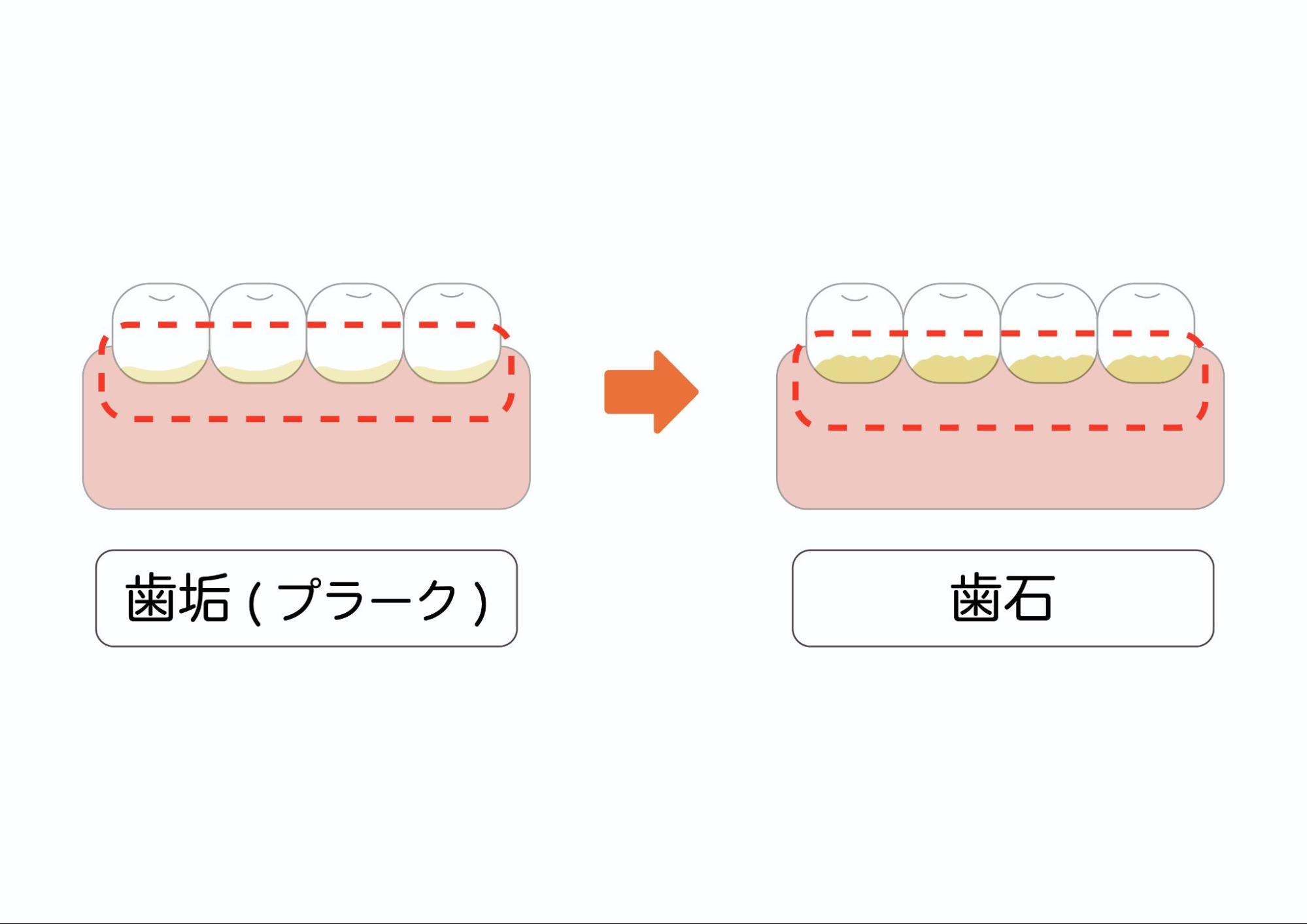 歯垢（プラーク）とは｜歯石との違いは？歯垢がつきやすい人や簡単な取り方｜wakanote