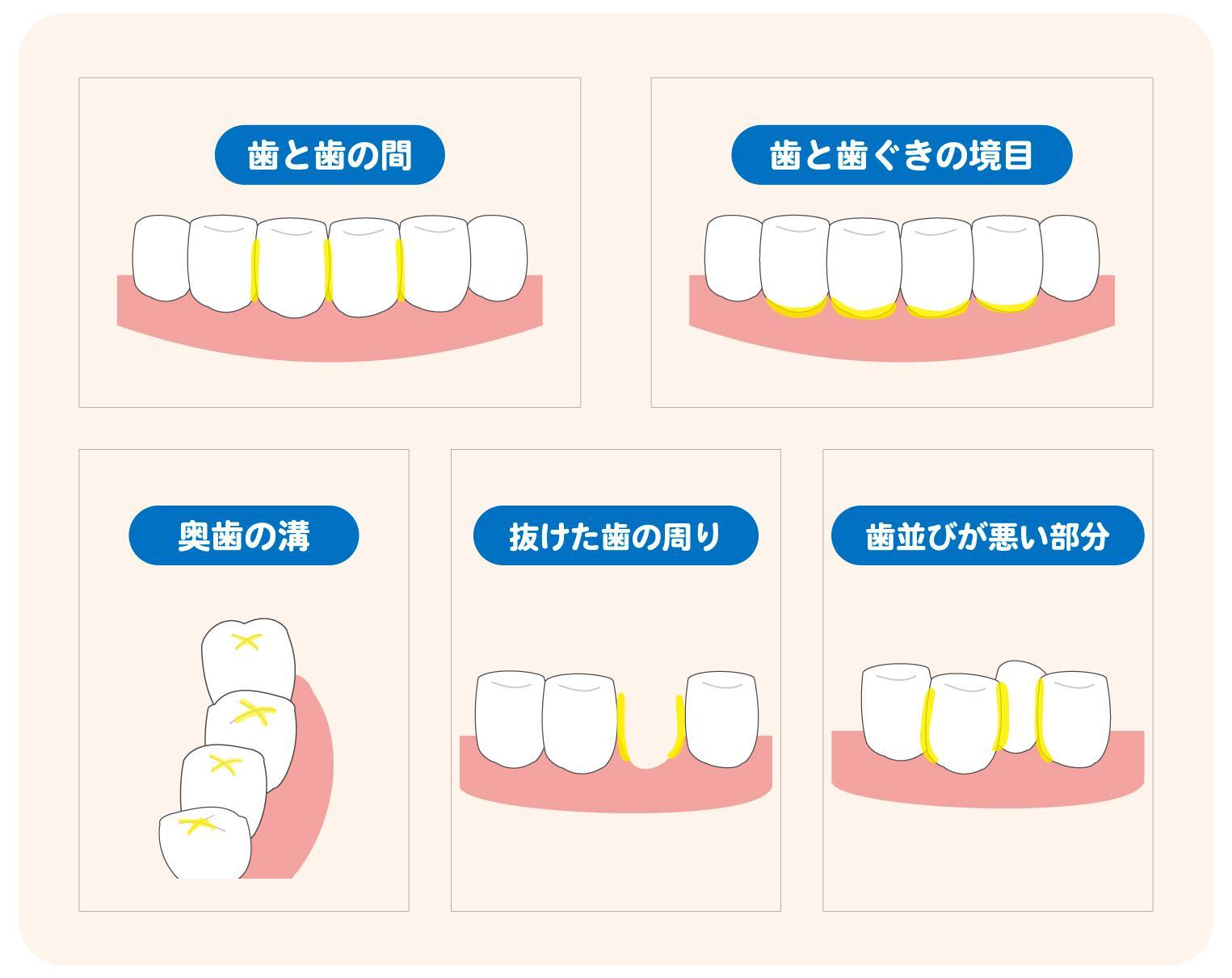 歯石原因, 歯石 どれくらいで作られる – OUHP