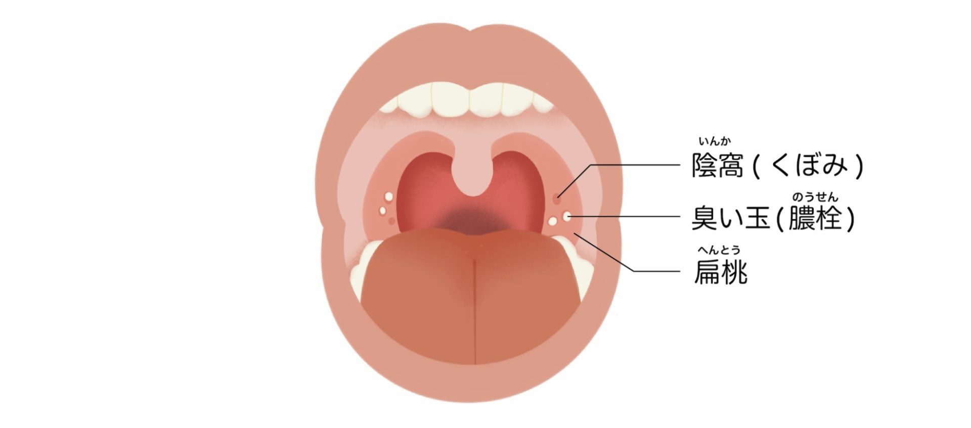 口臭 喉 の 痛み