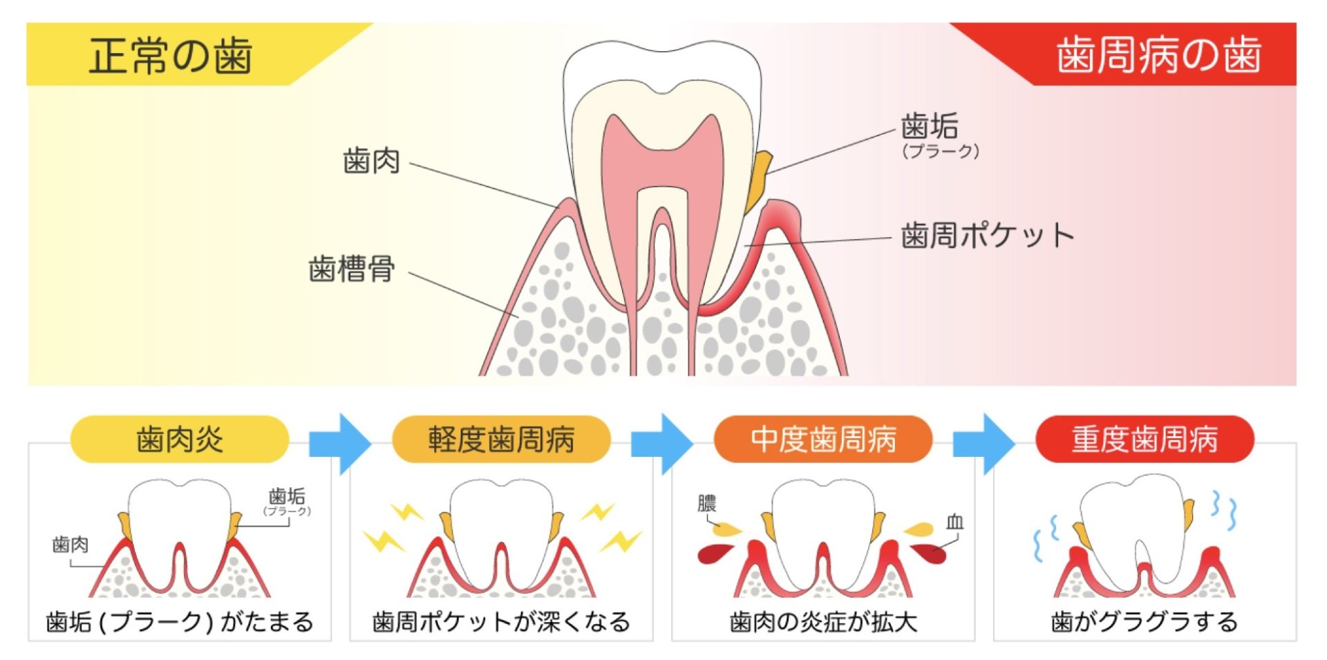 歯茎（歯ぐき）からの出血は『歯周病』が原因？！血が出た時の対処法を解説｜wakanote